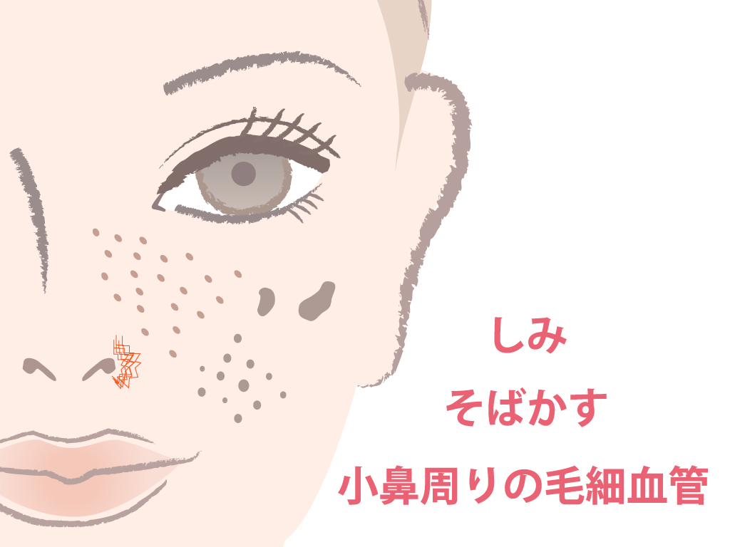 AcuTip500とは